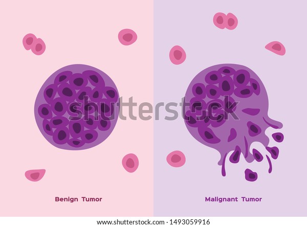 cancer and tumor cell stage and development\
vector	/  malignant and benign\
type