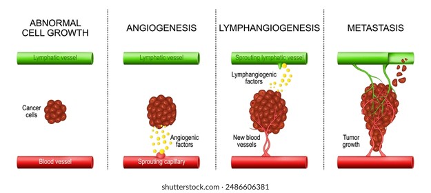 Cáncer. Desarrollo tumoral desde crecimiento celular anormal, linfangiogénesis y angiogénesis hasta metástasis. Diseminar las células cancerosas desde un sitio inicial a otros tejidos. Invasión de cáncer. Crecimiento tumoral.