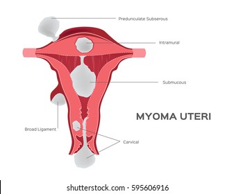 cancer and tumor in women uterus vector