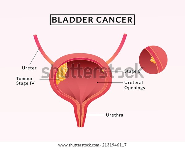 Cancer of urinary bladder. Human Bladder
Anatomy.  medical
illustration.
