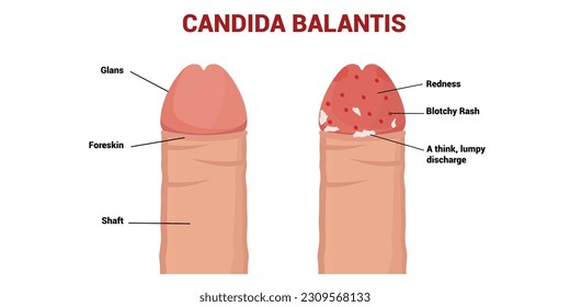 Ilustración vectorial de Candida Balanitis.    Penes sanos e infectados