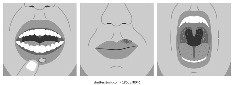 A Canker Sore, Cold Sore, And Sore Throat. Black And White Vector Illustration Of Aphthous Ulcer, Chronic And Bacterial Tonsillitis.