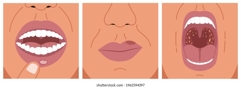 A Canker Sore, Cold Sore, And Sore Throat. Vector Illustration Of Aphthous Ulcer, Chronic And Bacterial Tonsillitis.