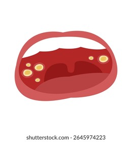 canker sore in mouth. vector illustration