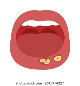 canker sore in mouth. vector illustration
