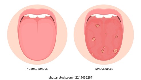Geschwüre der Zunge und Krebsgeschwüre im Mund und orale