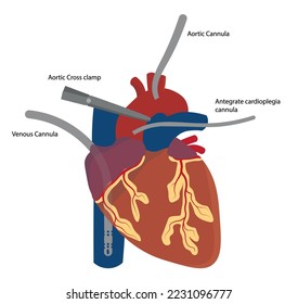 Corazón Cannulado para una cirugía cardiaca tórax abierta. Cannula del sistema de derivación cardiopumonar posicionada