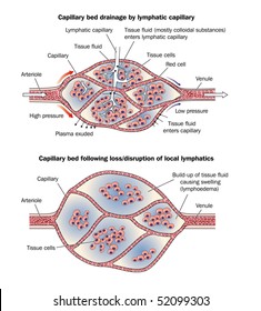 Capillary Bed Showing Lymphoedema -- Labeled