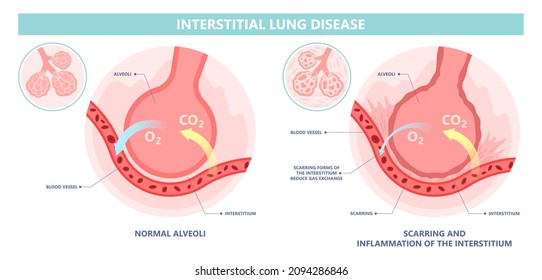 Capillary dry cough of wood metal dust breath virus Chest X-ray Cancer scan High resolution HRCT Biopsy usual COPD chronic asbestos corona covid 19 cystic diagnose disorder dyspnea fibers ILD UIP IPF