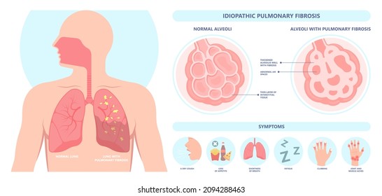 Capillary dry cough of wood metal dust breath virus Chest X-ray Cancer scan High resolution HRCT Biopsy usual COPD chronic asbestos corona covid 19 cystic diagnose disorder dyspnea fibers ILD UIP IPF