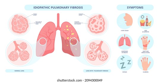 Capillary dry cough of wood metal dust breath virus Chest X-ray Cancer scan High resolution HRCT Biopsy usual COPD chronic asbestos corona covid 19 cystic diagnose disorder dyspnea fibers ILD UIP IPF