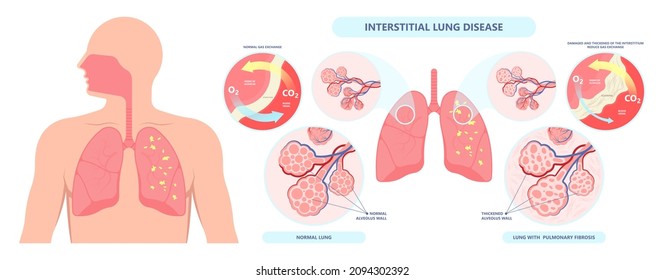 Capillary dry cough of wood metal dust breath virus Chest X-ray Cancer scan High resolution HRCT Biopsy usual COPD chronic asbestos corona covid 19 cystic diagnose disorder dyspnea fibers ILD UIP IPF