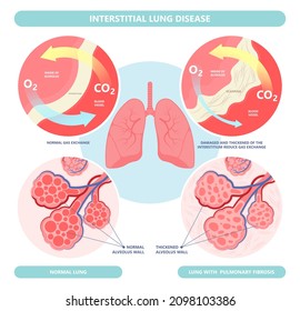 Capillary dry cough of wood metal dust breath virus Chest X-ray Cancer scan High resolution HRCT Biopsy usual COPD chronic asbestos corona covid 19 cystic diagnose disorder dyspnea fibers ILD UIP IPF