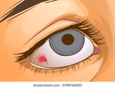 A capillary in the eye burst. Inflammation of the cornea. Close-up illustration of the human eye. Healthcare illustration. Vector illustration. 