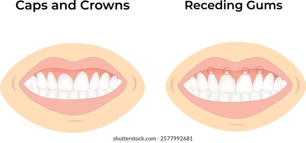 Caps Crowns and Receding Gums Design Vector Illustration