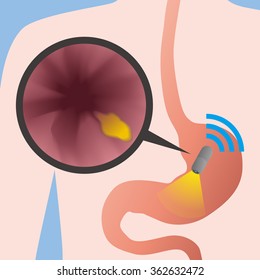 Capsule Endoscopy, Vector Illustration