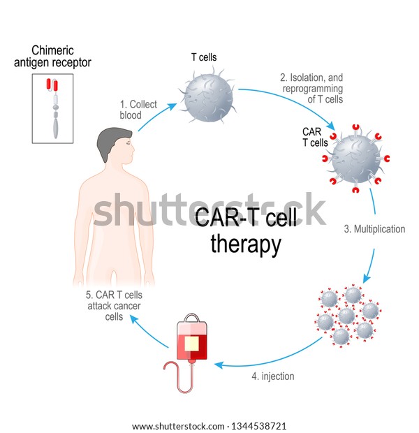 CAR T-cell\
therapy. Artificial leukocyte receptors are proteins that have been\
engineered for cancer immunotherapy (killing of tumor cells).\
genetically engineered. Vector\
diagram