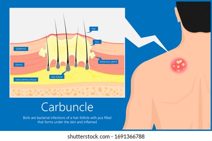 Carbuncle Boils Bacterial Infection Under Skin Hair Follicle Pus Head Irritated Lump Soap Swollen Methicillin Resistant MRSA Antibiotic Exam