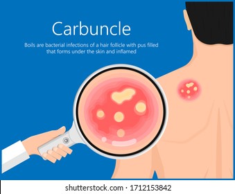 Carbuncle Boils Bacterial Infection Under Skin Hair Follicle Pus Head Irritated Lump Soap Swollen Methicillin Resistant MRSA Antibiotic Exam