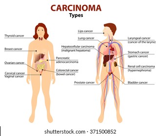 Carcinoma. Type of cancer. Woman and man silhouette with highlighted internal organs.