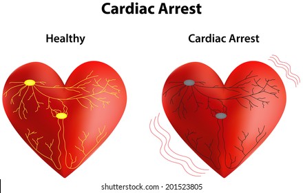 Cardiac Arrest Diagram