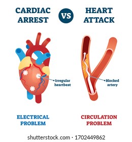 Cardiac arrest vs heart attack vector illustration. Labeled health problems comparison - electrical or circulation caused. Medical educational sick organ failure diagnosis scheme with explanation.