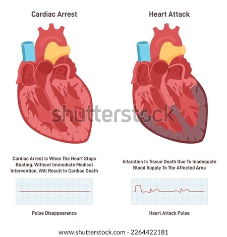 Cardiac arrest vs heart attack. Heart diseases comparison. Electrical signal or blood circulation lack. Life threatening organ failure. Flat vector illustration