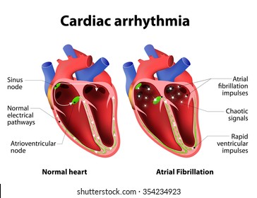 Cardiac Arrhythmia. Cardiac Dysrhythmia Or Irregular Heartbeat. Medical Illustration