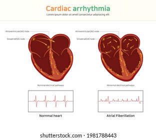 Cardiac Arrhythmia. Wolff-parkinson-white Syndrome. Atrial Fibrillation