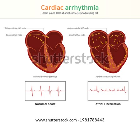 Cardiac arrhythmia. wolff-parkinson-white syndrome. atrial fibrillation