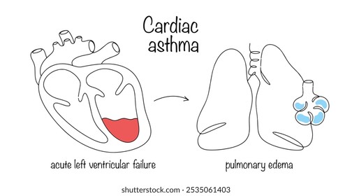 Asthma des Herzens. Eine Erkrankung, die mit akuten Lungenödemen aufgrund von linksventrikulärem Versagen des Herzens auftritt. Ein handgezeichnetes Diagramm des Auftretens und der Entwicklung dieser Pathologie. Vektor.