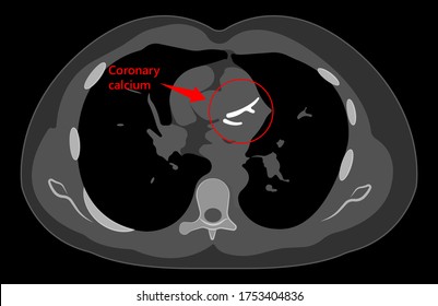 Cardiac Calcium Scoring Chest Health Signs X-ray Block Treat Blood Heart Score Cath Cell Pain Exam Clot Risk Test Scan Lab Fat CAD CAC CT