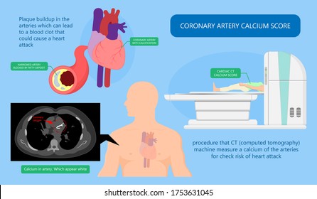 Cardiac Calcium Scoring Chest Health Signs X-ray Block Treat Blood Heart Score Cath Cell Pain Exam Clot Risk Test Scan Lab Fat CAD CAC CT