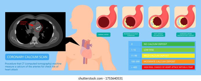 Cardiac Calcium Scoring Chest Health Signs X-ray Block Treat Blood Heart Score Cath Cell Pain Exam Clot Risk Test Scan Lab Fat CAD CAC CT