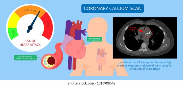 Cardiac Calcium Scoring Chest Health Signs X-ray Block Treat Blood Heart Score Cath Cell Pain Exam Clot Risk Test Scan Lab Fat CAD CAC CT