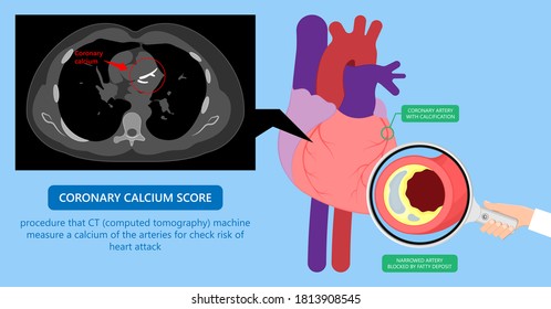 Cardiac Calcium Scoring Chest Health Signs X-ray Block Treat Blood Heart Score Cath Cell Pain Exam Clot Risk Test Scan Lab Fat CAD CAC CT