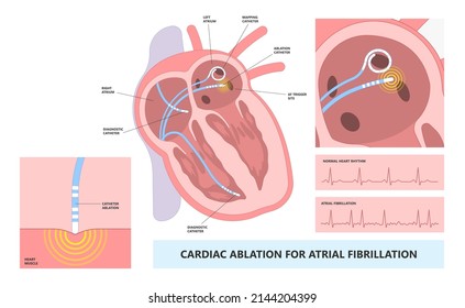 Cardiac catheter ablation Atrial fibrillation minimally invasive procedure rhythm problem cath lab treat treatment Coronary x-ray Radio frequency Sinus Ventricular SVT ECG ICD Radiofrequency attack