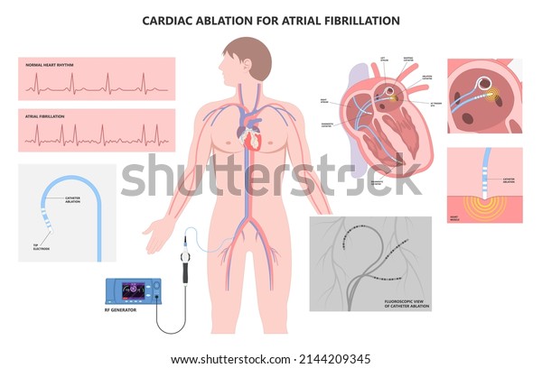 Cardiac catheter ablation Atrial fibrillation
minimally invasive procedure rhythm problem cath lab treat
treatment Coronary x-ray Radio frequency Sinus Ventricular SVT ECG
ICD Radiofrequency
attack