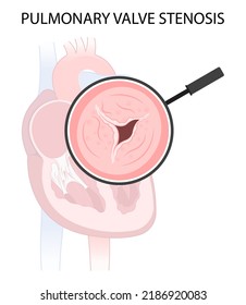 cardiac heart murmur disease Cath lab for TAVI or TAVR stroke aortic repair right left atrial fever atresia mitral valve floppy with Barlow birth syndrome rhythm atrium balloon surgery