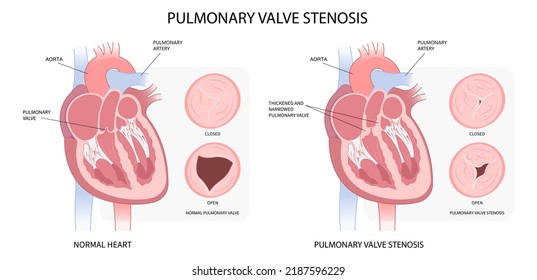 Comparación entre estenosis normal y pulmonar de la válvula cardíaca en