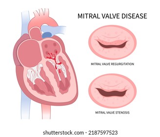 cardiac heart murmur disease Cath lab for TAVI or TAVR stroke aortic repair right left atrial fever atresia mitral valve floppy with Barlow birth syndrome rhythm atrium balloon surgery