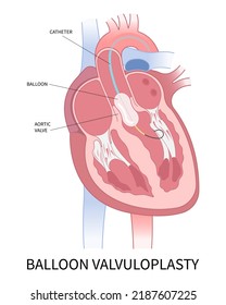 cardiac heart murmur disease Cath lab for TAVI or TAVR stroke aortic repair right left atrial fever atresia mitral valve floppy with Barlow birth syndrome rhythm atrium balloon surgery