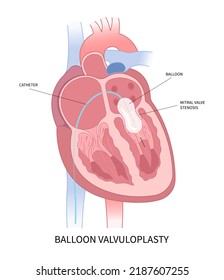 cardiac heart murmur disease Cath lab for TAVI or TAVR stroke aortic repair right left atrial fever atresia mitral valve floppy with Barlow birth syndrome rhythm atrium balloon surgery