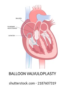 cardiac heart murmur disease Cath lab for TAVI or TAVR stroke aortic repair right left atrial fever atresia mitral valve floppy with Barlow birth syndrome rhythm atrium balloon surgery