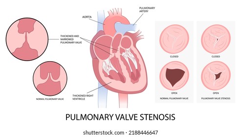 cardiac heart murmur disease Cath lab for TAVI or TAVR stroke aortic repair right left atrial fever atresia mitral valve floppy with Barlow birth syndrome rhythm atrium balloon surgery