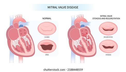 cardiac heart murmur disease Cath lab for TAVI or TAVR stroke aortic repair right left atrial fever atresia mitral valve floppy with Barlow birth syndrome rhythm atrium balloon surgery