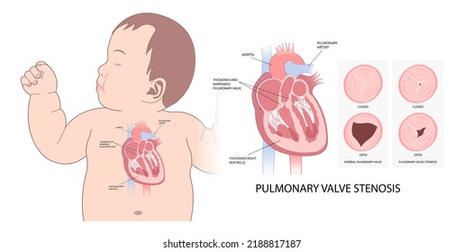 cardiac heart murmur disease Cath lab for TAVI or TAVR stroke aortic repair right left atrial fever atresia mitral valve floppy with Barlow birth syndrome rhythm atrium balloon surgery