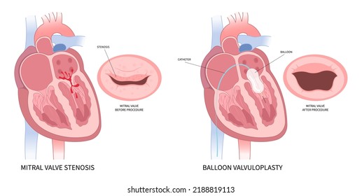 cardiac heart murmur disease Cath lab for TAVI or TAVR stroke aortic repair right left atrial fever atresia mitral valve floppy with Barlow birth syndrome rhythm atrium balloon surgery