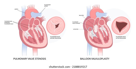 Cardiac Heart Murmur Disease Cath Lab For TAVI Or TAVR Stroke Aortic Repair Right Left Atrial Fever Atresia Mitral Valve Floppy With Barlow Birth Syndrome Rhythm Atrium Balloon Surgery