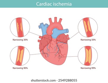 Isquemia cardíaca. Ilustración anatómica dibujada en estilo de dibujos animados